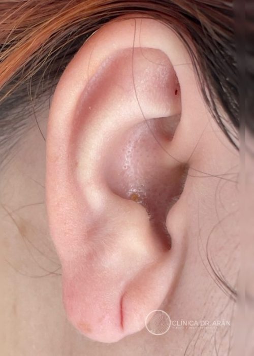 lobuloplastia 3 A dr aran