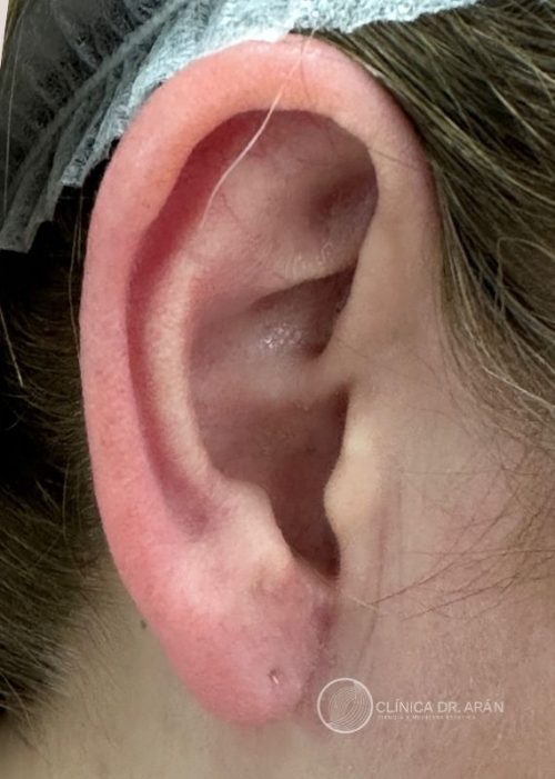 lobuloplastia 3 D dr aran