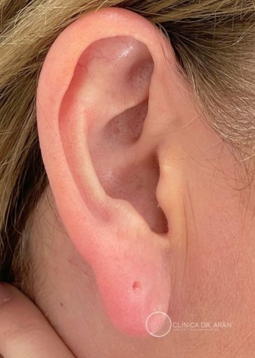 lobuloplastia 4 A dr aran